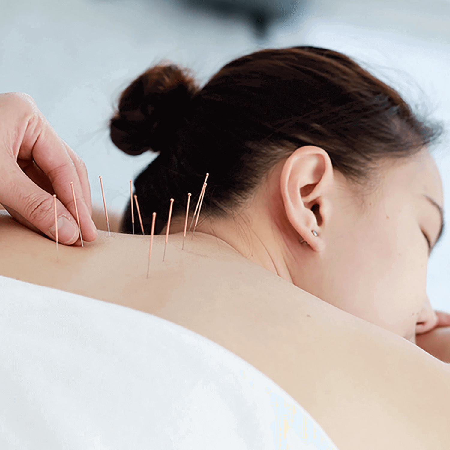 Acupuncture